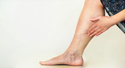 Endovenous Laser Treatment