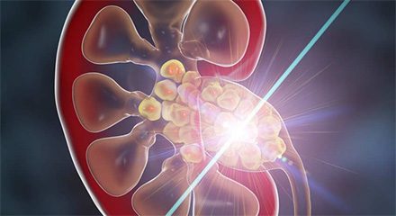 Laser Lithotripsy Treatments & Procedures 1 Laser Lithotripsy