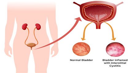 How is interstitial cystitis diagnosis? 1 interstitial cystitis diagnosis