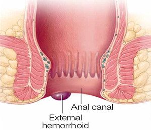 Different types of hemorrhoids images & symptoms 1 external hemorrhoids images