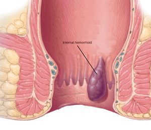 Different types of hemorrhoids images & symptoms 2 internal hemorrhoids pictures