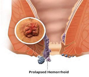 prolapsed hemorrhoids images