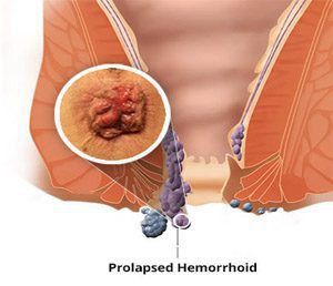 Different types of hemorrhoids images & symptoms 4 prolapsed hemorrhoids images