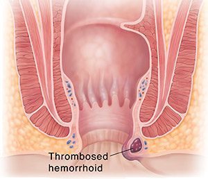 Different types of hemorrhoids images & symptoms 3 thrombosed hemorrhoids pictures
