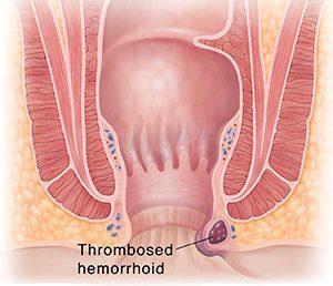 thrombosed hemorrhoids pictures