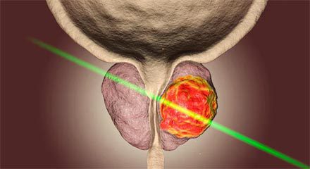 laser ablation