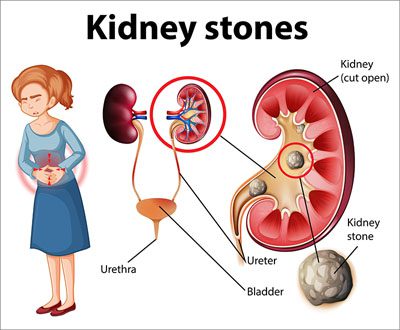 Home remedies for kidney stones