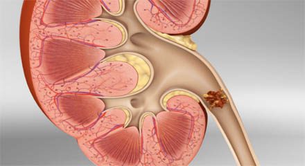 What food avoid in kidney stone? 1 kidney stone