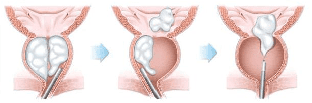 HoLEP vs UroLift:Which is better for treating BPH? 2 HoLEP