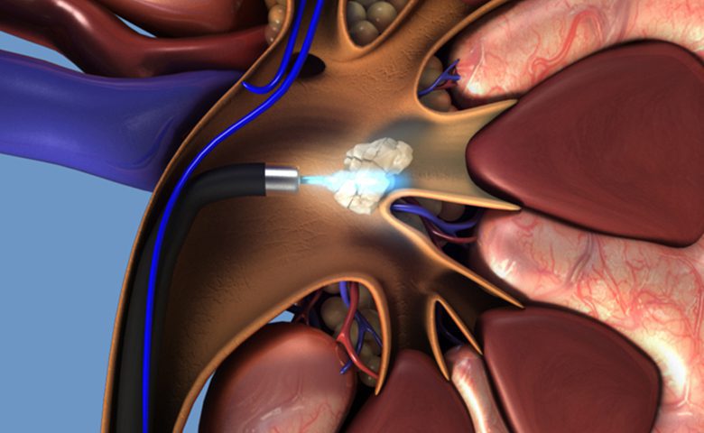 What is the most effective method of lithotripsy (4)