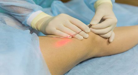 Endovenous laser therapy for varicose veins