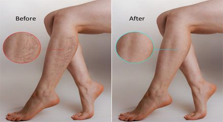 Varicose veins laser treatment before and after