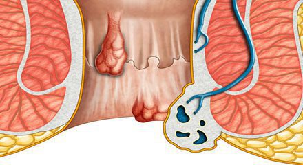 laser hemorrhoidectomy