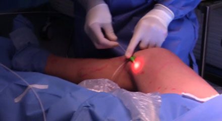 endovenous laser treatment