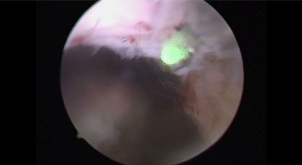 Holmium Laser Enucleation Of The Prostate(HZ Series)